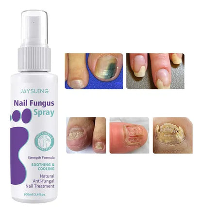 Spray Antifúngico para Uñas